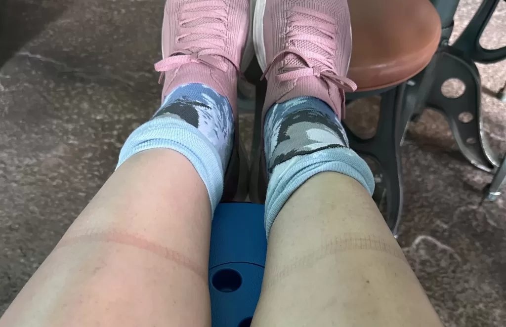 Tight sock marks due to blood pooling after a day of walking at Tokyo DisneySea